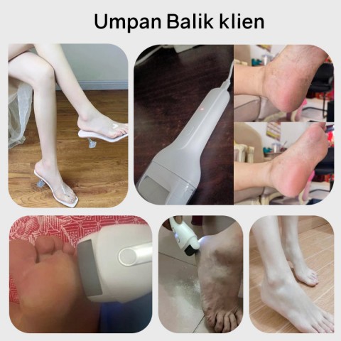 Penghilang kalus kaki listrik portabel