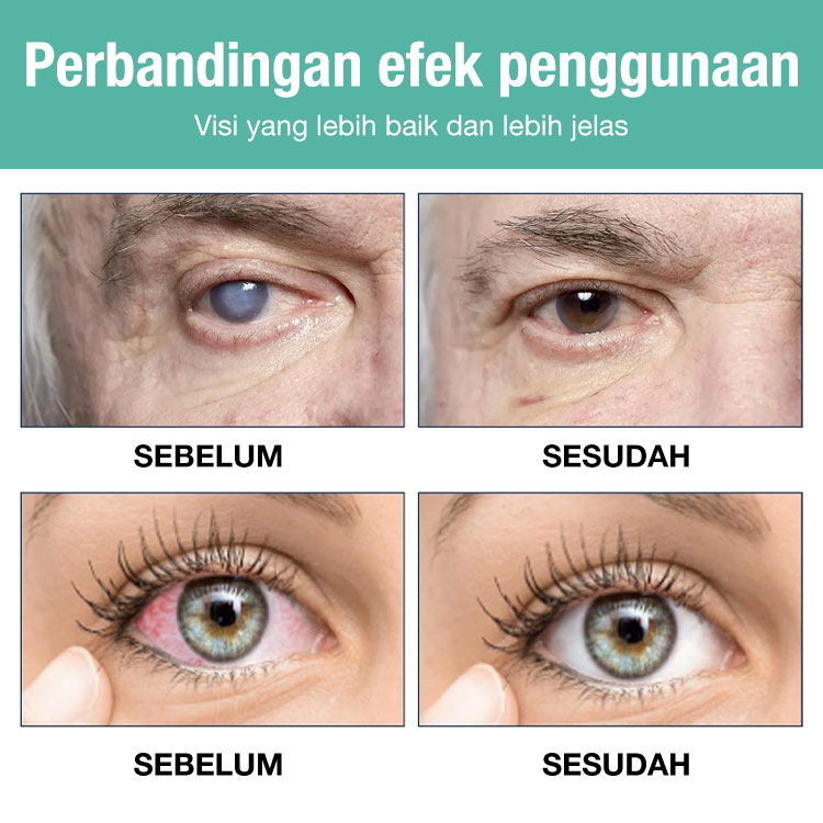 Promosi Hari Kemerdekaan-Beli 1 Gratis 1 - Rol peningkatan penglihatan - Ucapkan selamat tinggal pada ketidaknyamanan mata dimulai hari ini!